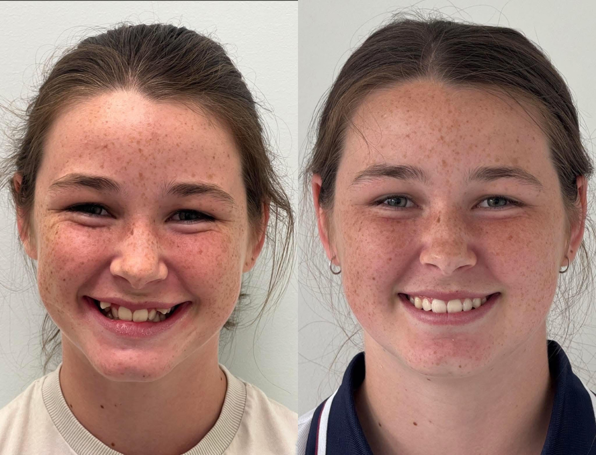 Emily — Gap Closure before and after Invisalign at Erskine Park Dental