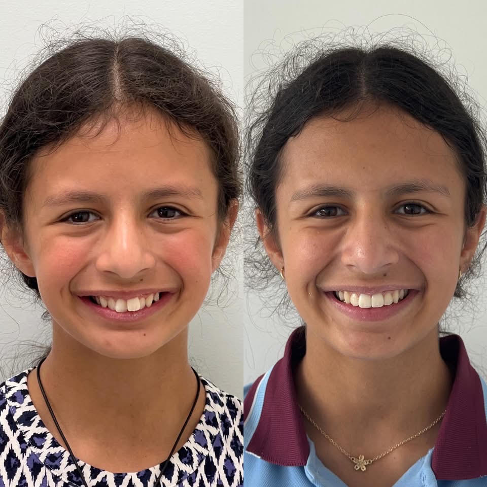 Charlotte — Crowding & Alignment before and after Invisalign at Erskine Park Dental