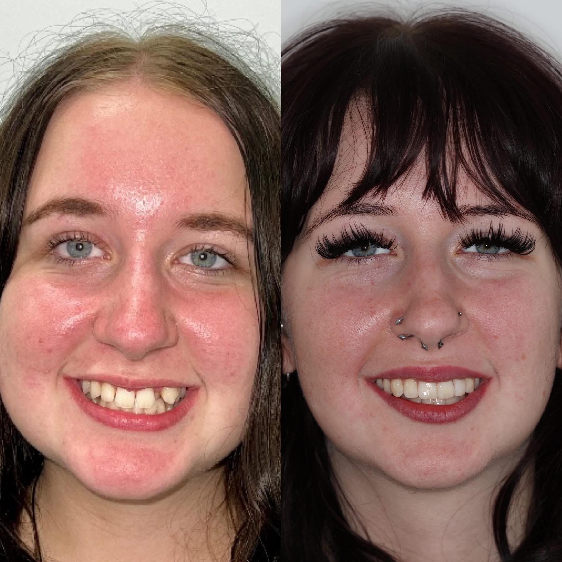 Jade — Spacing & Smile Reshape before and after Invisalign at Erskine Park Dental