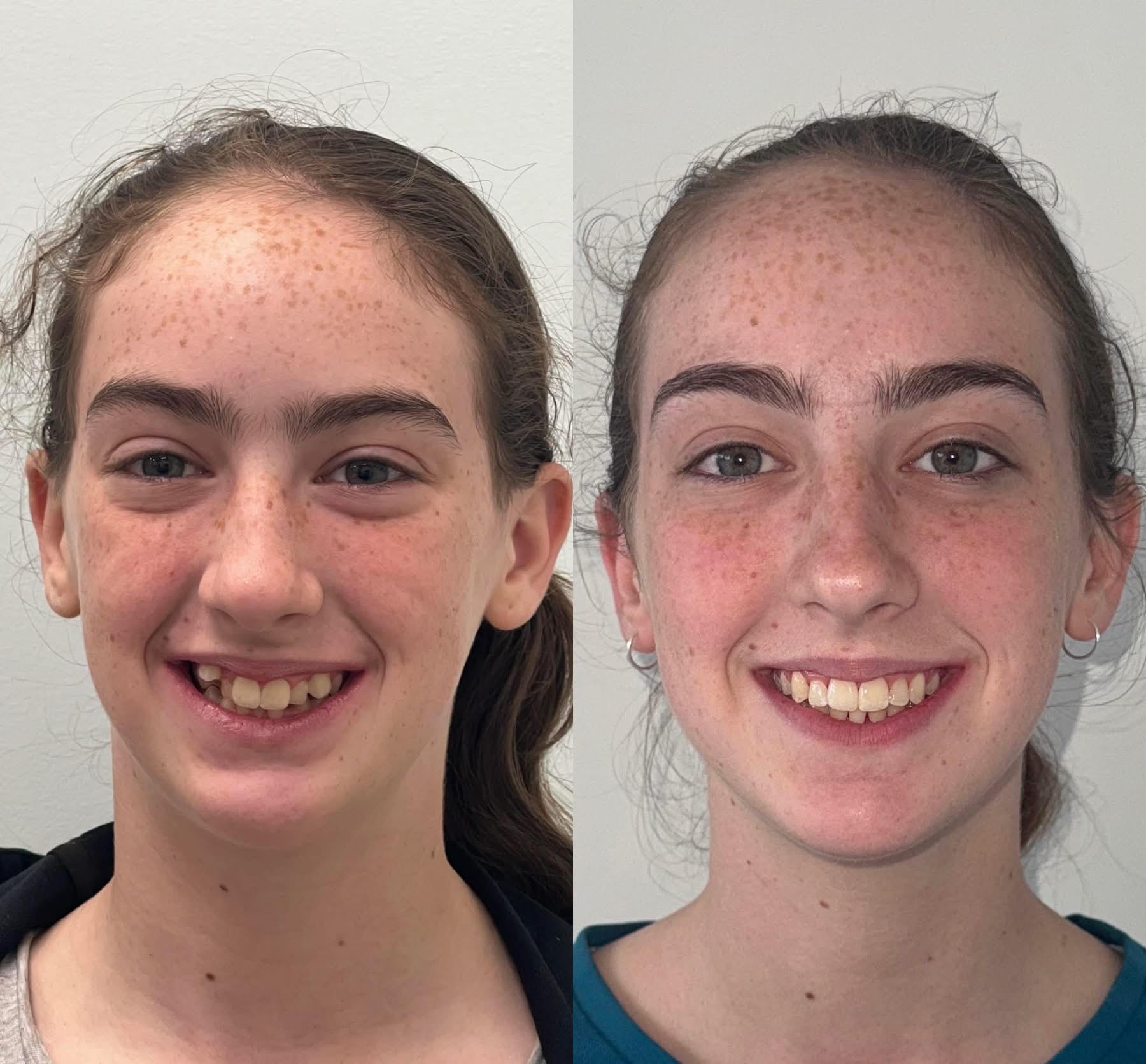Aurora — Spacing & Alignment before and after Invisalign at Erskine Park Dental